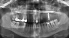 ОПТГ (ортопантомография) зубов