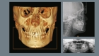 Компьютерная томография челюстно-лицевой области 