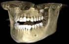 Компьютерная томография челюстно-лицевой области (16х18)