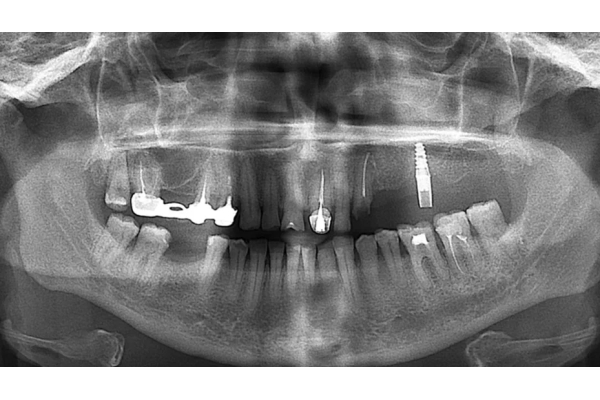 ОПТГ (ортопантомография) зубов