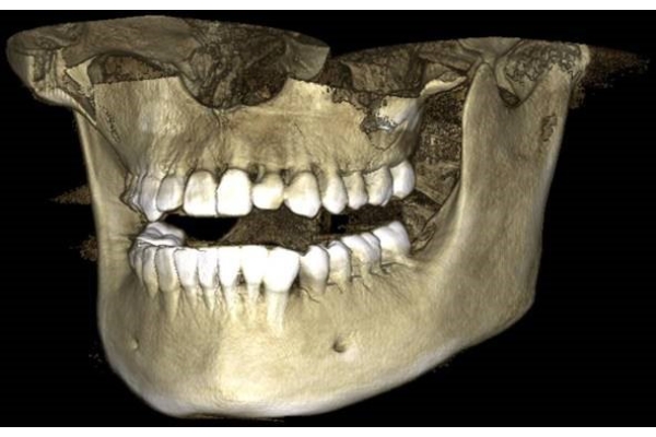 Компьютерная томография челюстно-лицевой области (16х18)
