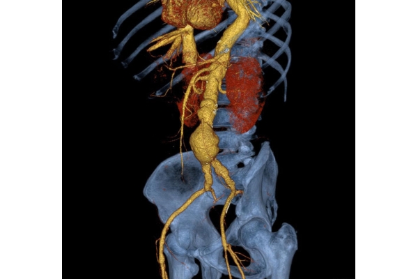 МРТ грудного отдела аорты с контрастным усилением: динамическим контрастированием (контрастной перфузией) в объеме 20 мл