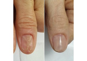 Протезирование ногтя на руке (маленький палец)
