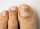 Обработка инфицированной/утолщенной ногтевой пластины (большой ноготь)