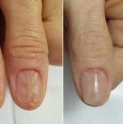 Протезирование ногтя на руке (маленький палец)